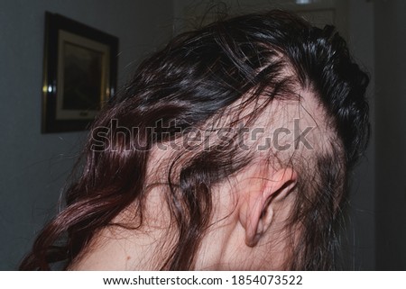 Woman suffering from alopecia areata condition. Hair loss concept