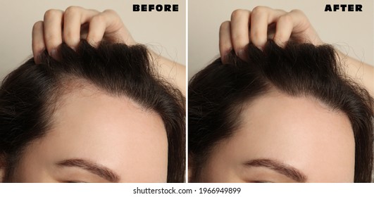 Woman suffering from baldness on beige background, closeup. Collage with photos before and after treatment