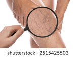 Woman suffering from varicose veins on white background, closeup. Affected leg, zoomed view through magnifying glass