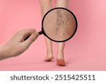 Woman suffering from varicose veins on pink background, closeup. Affected leg, zoomed view through magnifying glass