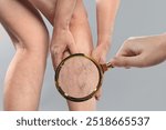 Woman suffering from varicose veins on light grey background, closeup. Affected leg, zoomed view through magnifying glass