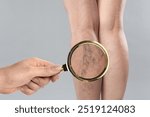 Woman suffering from varicose veins on light grey background, closeup. Affected leg, zoomed view through magnifying glass