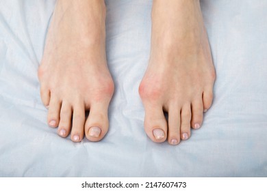 The Woman Suffers From Inflammation Of The Big Toe Bone. Hallux Valgus, Bunion In Foot On White Background.