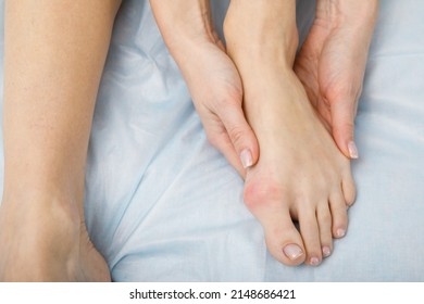 The Woman Suffers From Inflammation Of The Big Toe Bone. Hallux Valgus, Bunion In Foot On White Background.