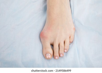 The Woman Suffers From Inflammation Of The Big Toe Bone. Hallux Valgus, Bunion In Foot On White Background.