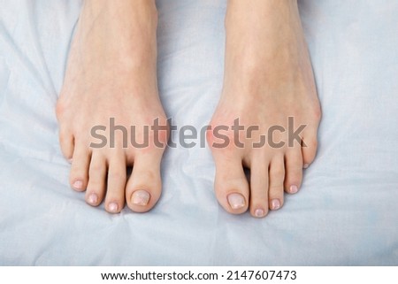 The woman suffers from inflammation of the big toe bone. Hallux valgus, bunion in foot on white background.