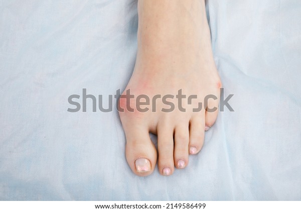 The woman suffers\
from inflammation of the big toe bone. Hallux valgus, bunion in\
foot on white background.