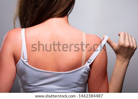 Woman with sunburn on back and shoulders