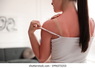 Woman With Sunburned Skin At Home, Closeup