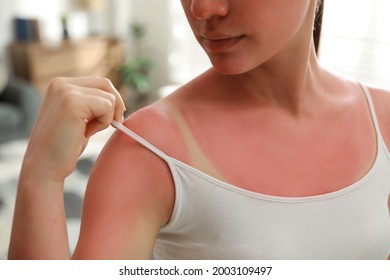 Woman With Sunburned Skin At Home, Closeup