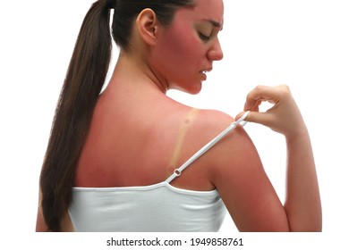 Woman With Sunburned Skin On White Background