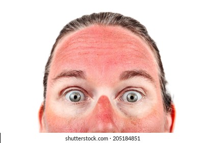 Woman With Sunglasess Sunburn