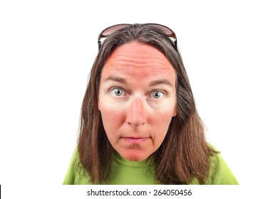 Woman With Sunglasses Sunburn