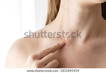 Woman with surgery scar at her neck. 