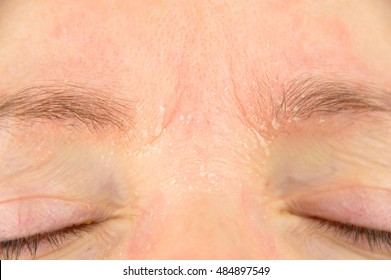 Woman With Symptom Of Atopic Dermatitis On Brow And Brows