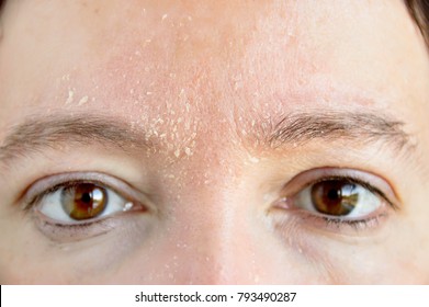 woman with symptom of atopic dermatitis on brow and brows