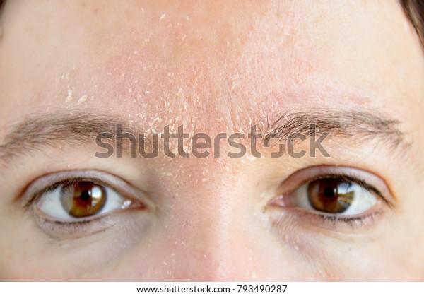 眉毛にアトピー性皮膚炎の症状を持つ患者 の写真素材 今すぐ編集
