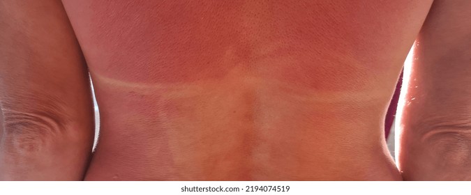 Woman With Tanned Red Back Skin Closeup. Sunburn Allergy Concept