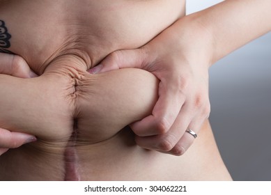 A Woman With A Tattoo Grabbing The Loose Skin On Her Stomach After Giving Birth By C-section.