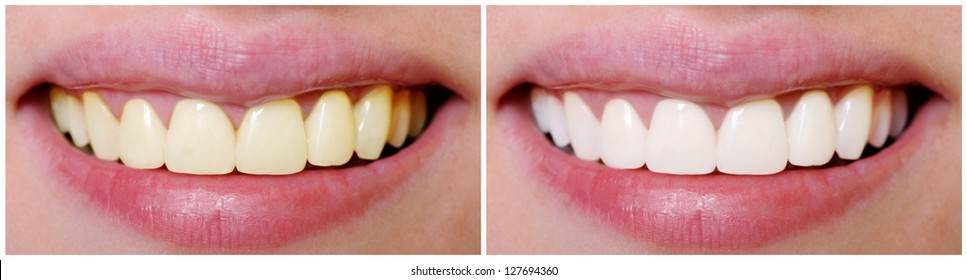 Woman teeth before and after whitening.