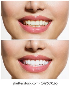 Woman Teeth Before and After Whitening. Over white background. Happy smiling woman. Dental health Concept. Oral Care