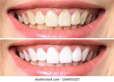 woman teeth before after whitening 260nw 1564955107
