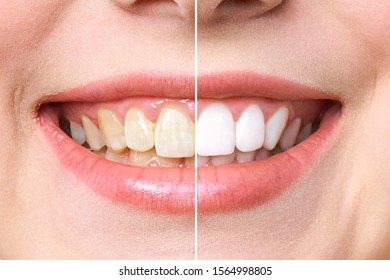 woman teeth before and after whitening. Over white background. Dental clinic patient. Image symbolizes oral care dentistry, stomatology. - Shutterstock ID 1564998805
