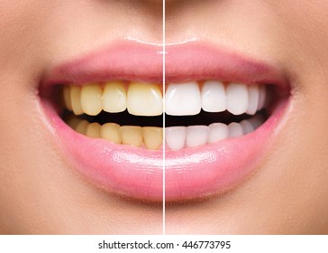Woman Teeth Before and After Whitening. Happy smiling woman. Dental health Concept. Oral Care concept