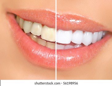 woman teeth before and after whitening. Over white background