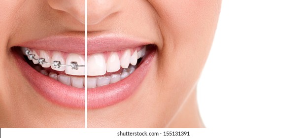 Woman Teeth And Smile. Close Up,half With Braces 