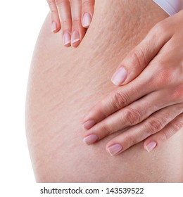 A Woman Is Testing The Skin On The Thigh For The Presence Of Stretch Marks And Cellulite