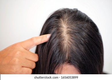 Woman With Thin Hair Problem.