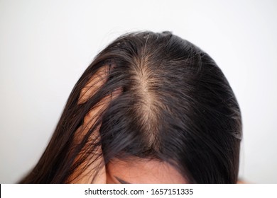 Woman With Thin Hair Problem.