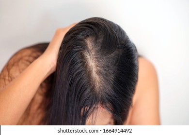 Woman With Thin Hair Problem.