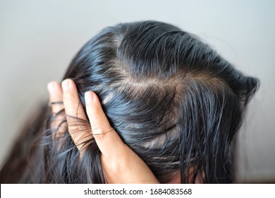 Woman With Thin Hair Problem.