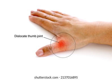 Woman With Thumb Pain Because Of Dislocated Thumb Joints Isolated On White Background.