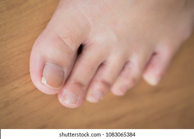 Woman Toe With Broken Nail; Woman Suffering From Home Accident, Kicking Something And Break Her Toe Nail, Foot Injury; Concept Of Minor Health Insurance; 30s Adult Asian Woman Foot And Toe Nail Model