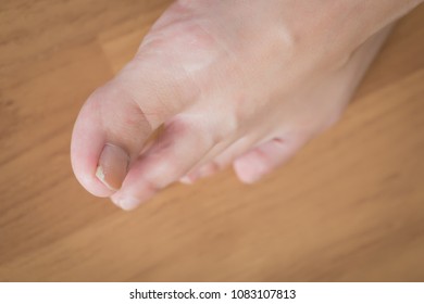 Woman Toe With Broken Nail; Woman Suffering From Home Accident, Kicking Something And Break Her Toe Nail, Foot Injury; Concept Of Minor Health Insurance; 30s Adult Asian Woman Foot And Toe Nail Model