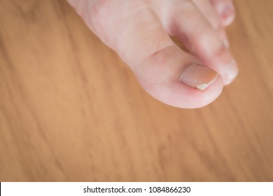 Woman Toe With Broken Nail; Woman Suffering From Home Accident, Kicking Something And Break Her Toe Nail, Foot Injury; Concept Of Minor Health Insurance; 30s Adult Asian Woman Foot And Toe Nail Model