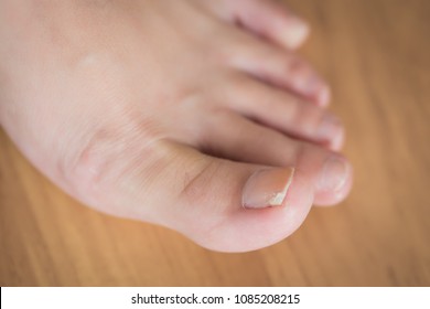 Woman Toe With Broken Nail; Woman Suffering From Home Accident, Kicking Something And Break Her Toe Nail, Foot Injury; Concept Of Minor Health Insurance; 30s Adult Asian Woman Foot And Toe Nail Model