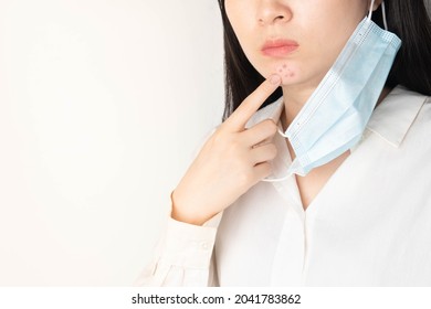 Woman touching acne on her chin that caused by wearing medical face mask, result in skin including redness, bumpiness, and irritation. Skin sensitive or allergic to the material of face covering.