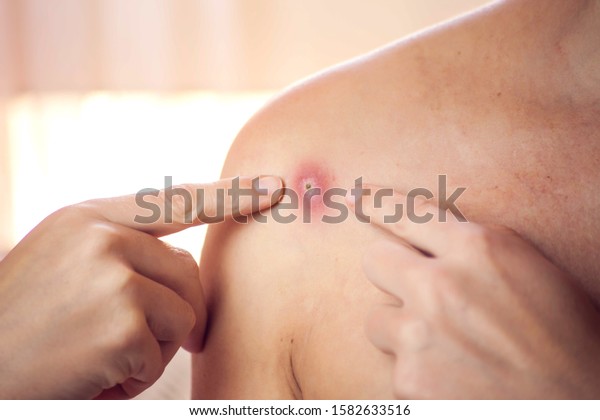 Woman tries to crush boil on her shoulder.\
People, medicine and skin care\
concept