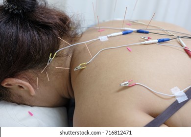 woman undergoing acupuncture treatment with electrical stimulator at hospital