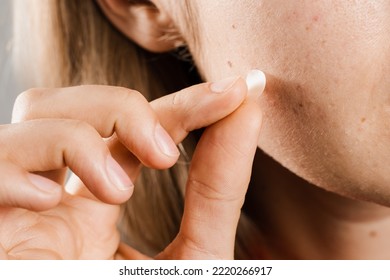 Woman Using Acne Patches For Treatment Of Pimple And Rosacea Close-up. Facial Rejuvenation Cleansing Cosmetology. Girl With Acne Stick Round Acne Patch On Her Cheek