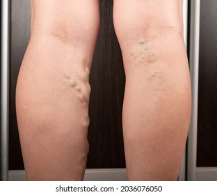 Woman With Varicose Legs, Thrombosis Of Distended Veins.