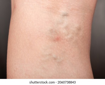 Woman With Varicose Legs, Thrombosis Of Distended Veins.