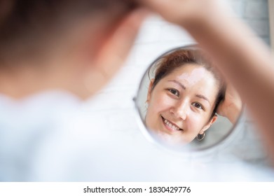 A Woman With Vitiligo Disease Looks In The Mirror