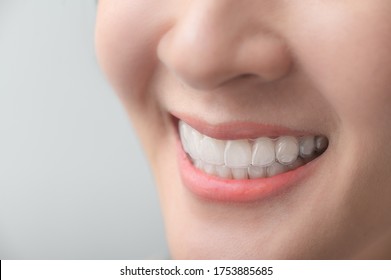 Woman wearing orthodontic silicone trainer. Mobile orthodontic appliance for dental correction. tooth whitening systems.