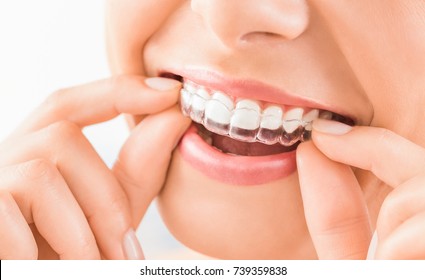 Woman wearing orthodontic silicone trainer. Invisible braces aligner. Mobile orthodontic appliance for dental correction. - Shutterstock ID 739359838