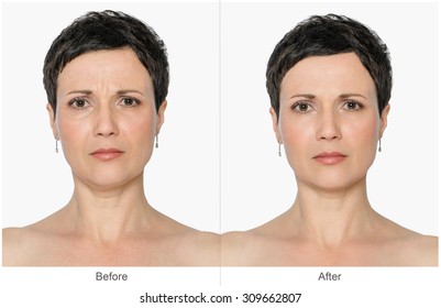 Woman with and without aging singes, double chin, worry wrinkles, nasolabial folds. Before and after cosmetic or plastic procedure, anti-age therapy, lifting, botox